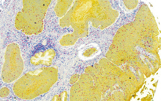 Uterine Cervix Squamous Cell Carcinoma: CD4, CD8, PanCK 5x